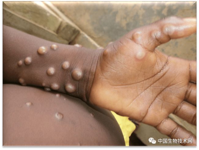 痘病毒，痘病毒科